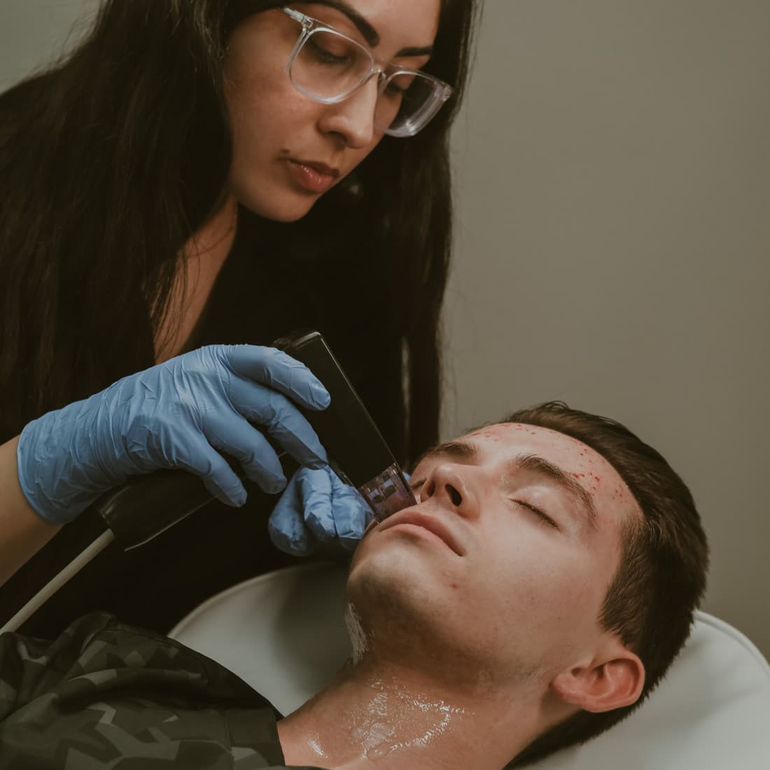 Morpheus8 radiofrequency microneedling treatment.